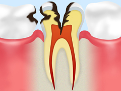 虫歯をそのまま放置するリスク